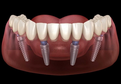 Kỹ thuật Implant All On: Giải pháp hoàn hảo cho người mất răng